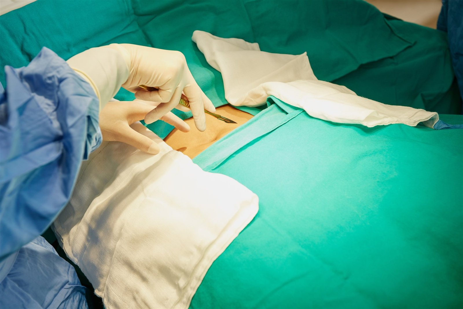 Laparoscopic Hysterectomy